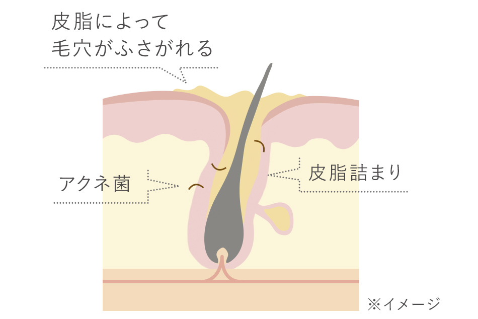 思春期ニキビの原因